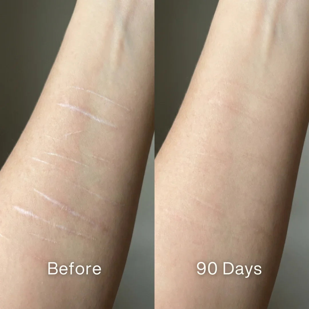 Scar Renewal - Advanced Medical Silicone