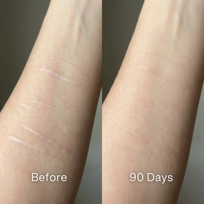 Scar Renewal - Advanced Medical Silicone