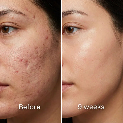 Scar Renewal - Advanced Medical Silicone