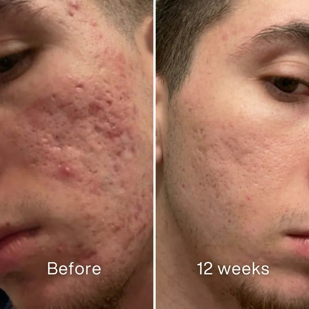 Clinical Acne Scar Remodeling Stick™